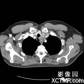 【双语病例】原发性气管软管肉瘤1例