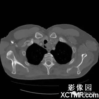 【双语病例】原发性气管软管肉瘤1例