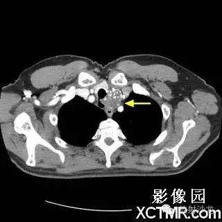 【双语病例】原发性气管软管肉瘤1例