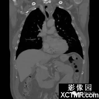 【双语病例】原发性气管软管肉瘤1例