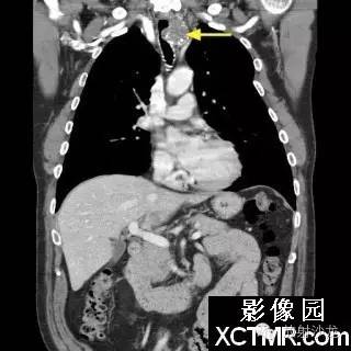 【双语病例】原发性气管软管肉瘤1例