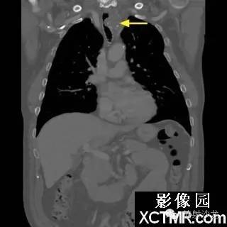 【双语病例】原发性气管软管肉瘤1例
