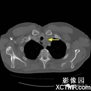 【双语病例】原发性气管软管肉瘤1例