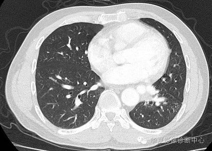 【病例】异常体动脉供血左肺下叶1例CT影像表现