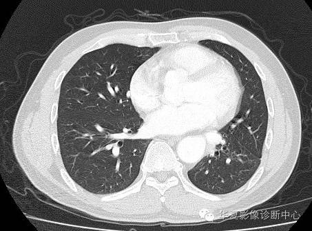 【病例】异常体动脉供血左肺下叶1例CT影像表现