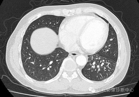 【病例】异常体动脉供血左肺下叶1例CT影像表现