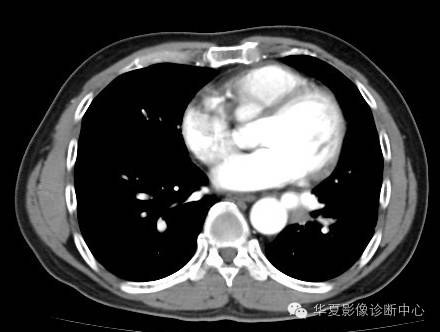 【病例】异常体动脉供血左肺下叶1例CT影像表现