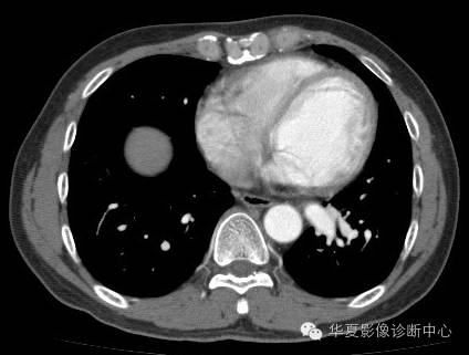 【病例】异常体动脉供血左肺下叶1例CT影像表现
