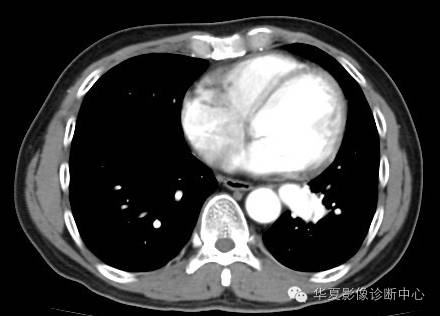 【病例】异常体动脉供血左肺下叶1例CT影像表现