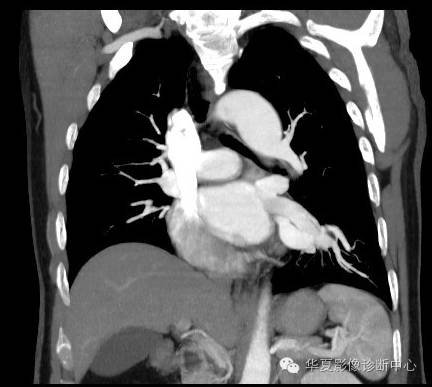 【病例】异常体动脉供血左肺下叶1例CT影像表现