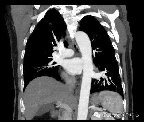 【病例】异常体动脉供血左肺下叶1例CT影像表现