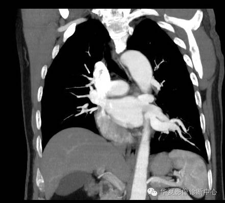 【病例】异常体动脉供血左肺下叶1例CT影像表现