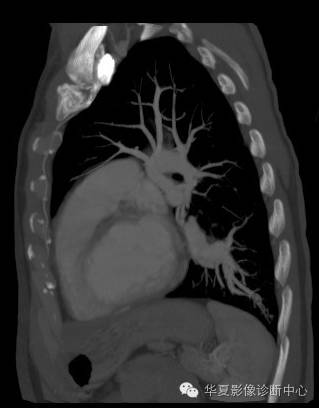 【病例】异常体动脉供血左肺下叶1例CT影像表现