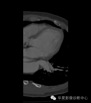 【病例】异常体动脉供血左肺下叶1例CT影像表现