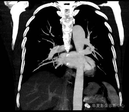 【病例】异常体动脉供血左肺下叶1例CT影像表现