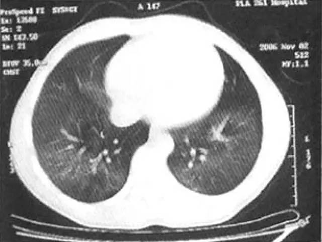多图解析：成人特发性肺含铁血黄素沉着症的影像学表现