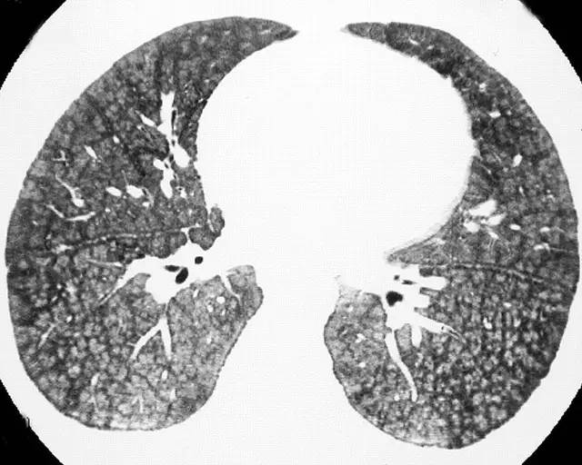 多图解析：成人特发性肺含铁血黄素沉着症的影像学表现