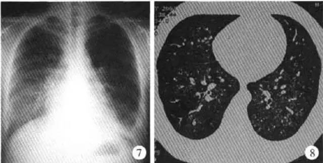 多图解析：成人特发性肺含铁血黄素沉着症的影像学表现