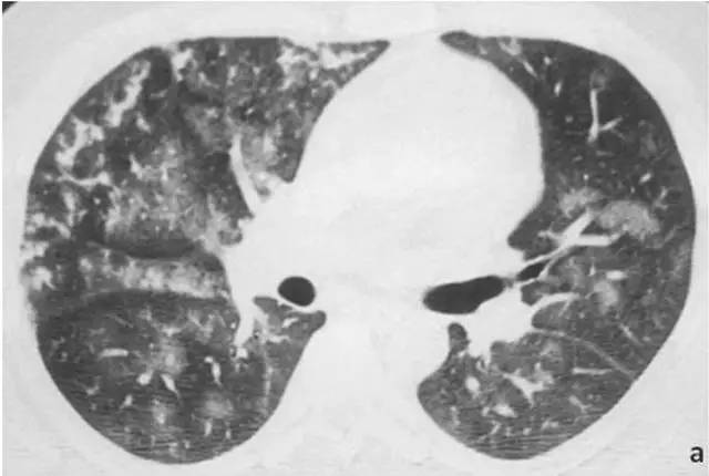 多图解析：成人特发性肺含铁血黄素沉着症的影像学表现