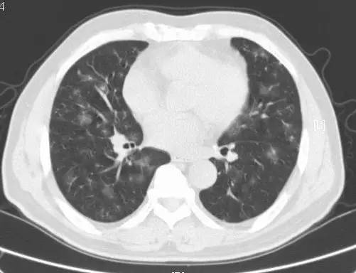 多图解析：成人特发性肺含铁血黄素沉着症的影像学表现