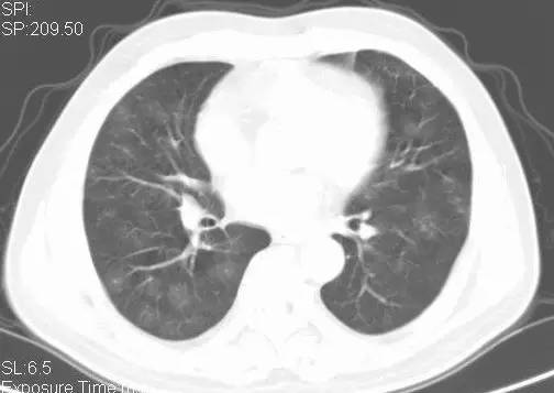 多图解析：成人特发性肺含铁血黄素沉着症的影像学表现