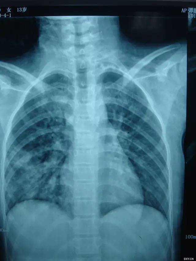 多图解析：成人特发性肺含铁血黄素沉着症的影像学表现