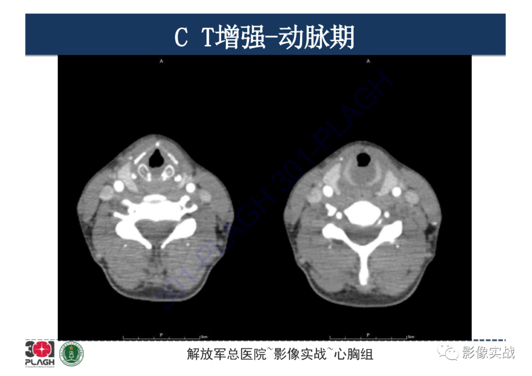 【病例】气管腺样囊性癌1例CT影像-3