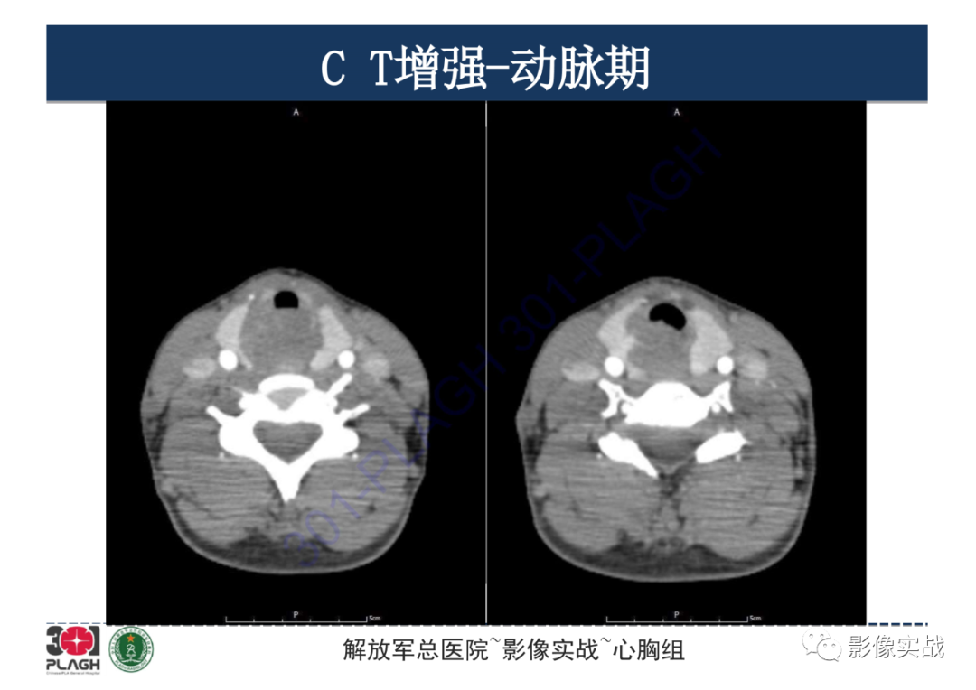 【病例】气管腺样囊性癌1例CT影像-4