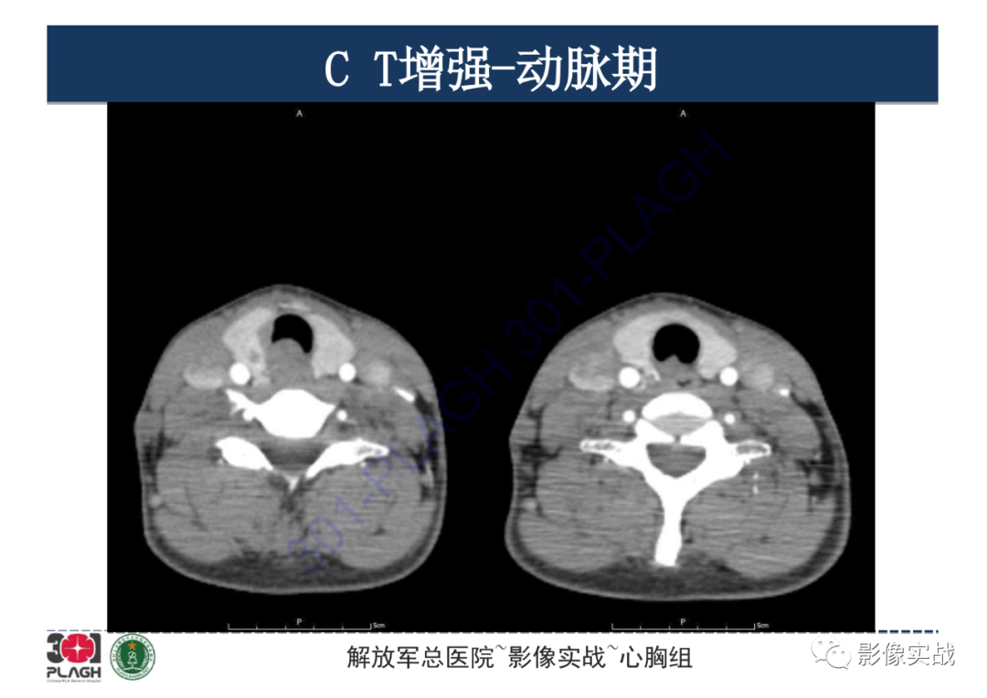 【病例】气管腺样囊性癌1例CT影像-5