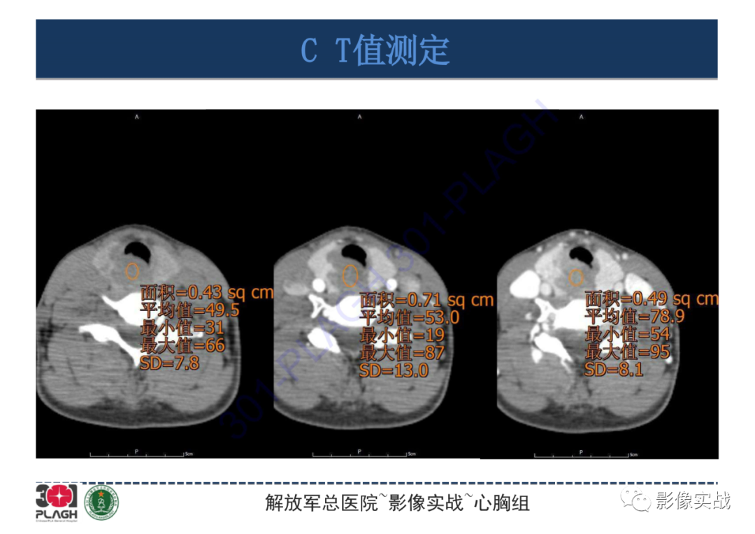 【病例】气管腺样囊性癌1例CT影像-6
