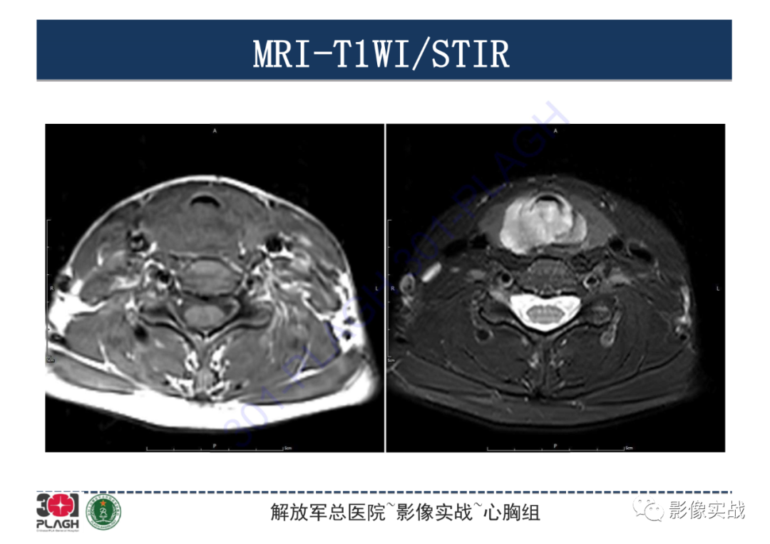 【病例】气管腺样囊性癌1例CT影像-7