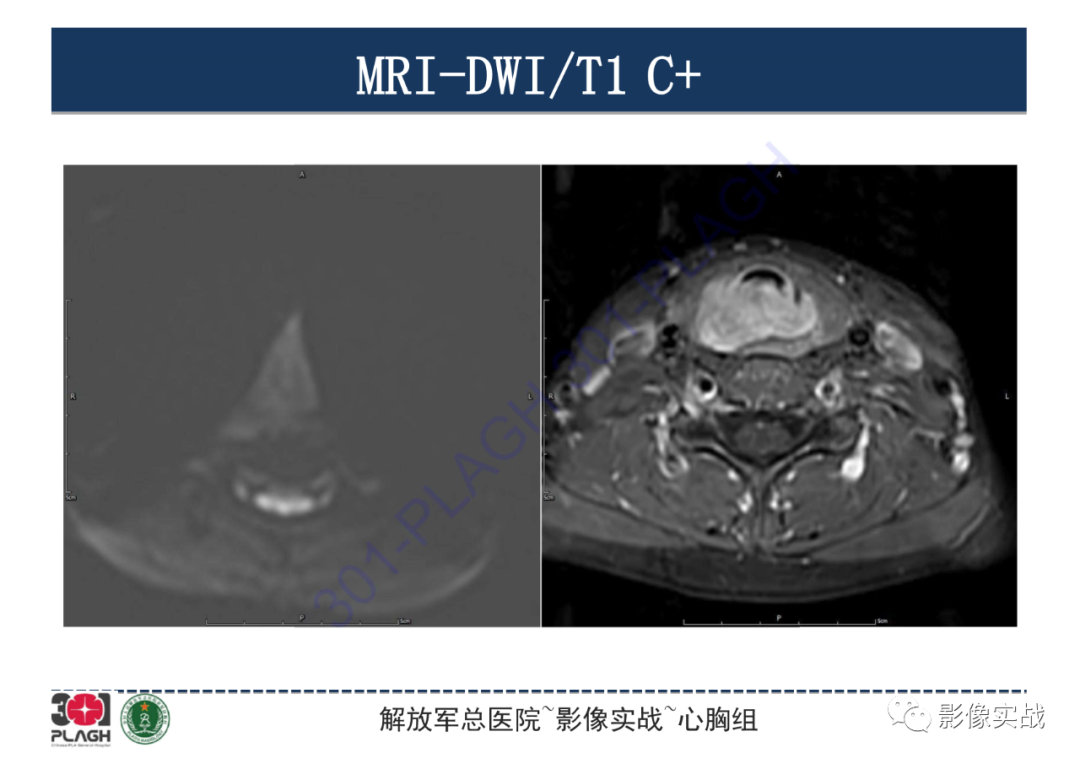 【病例】气管腺样囊性癌1例CT影像-8