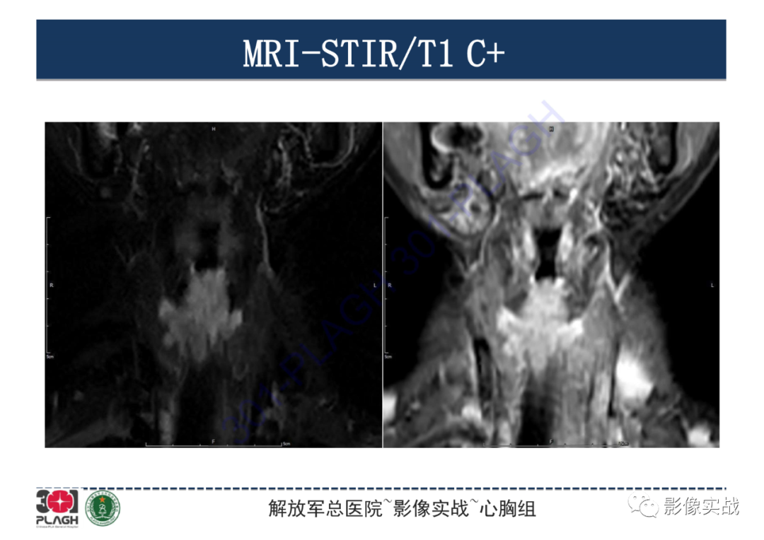【病例】气管腺样囊性癌1例CT影像-9