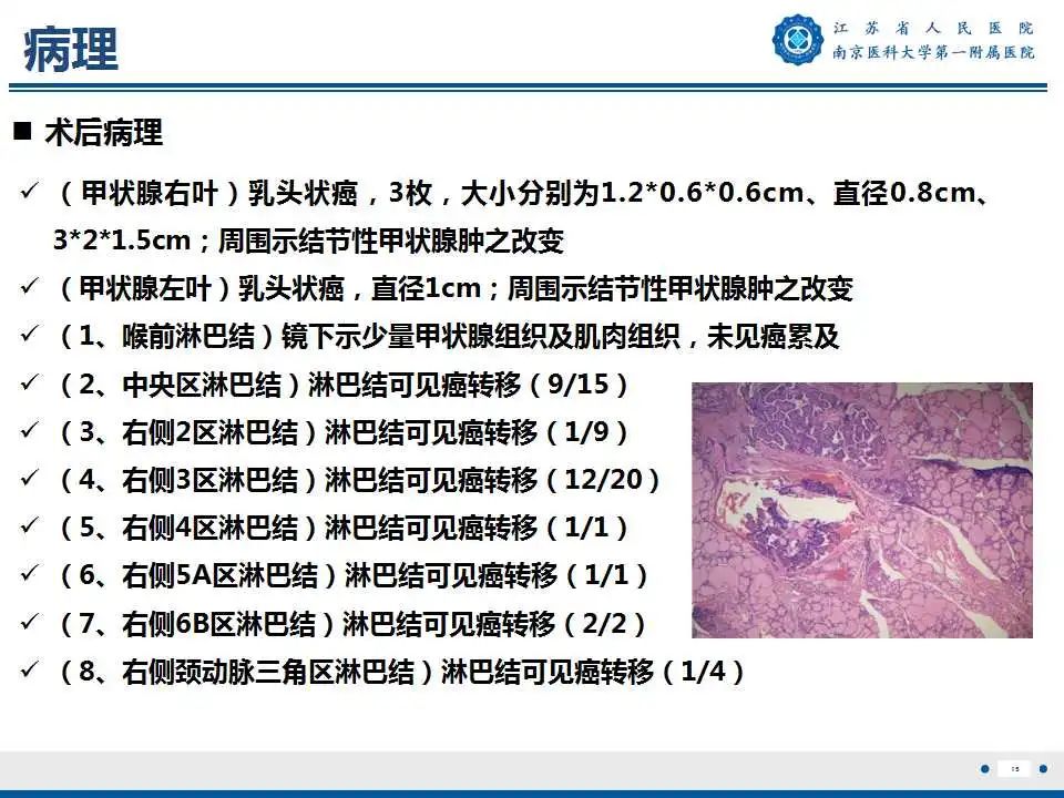 【PPT】甲状腺乳头状癌颈部淋巴结转移-16