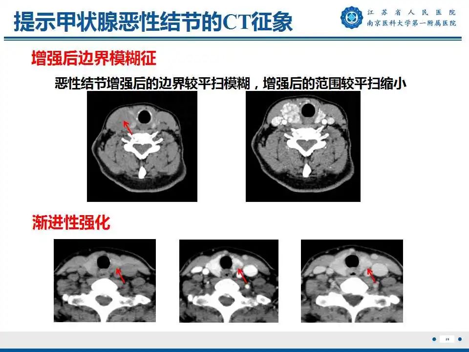 【PPT】甲状腺乳头状癌颈部淋巴结转移-29