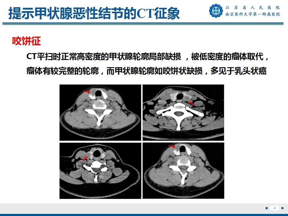 【PPT】甲状腺乳头状癌颈部淋巴结转移-28