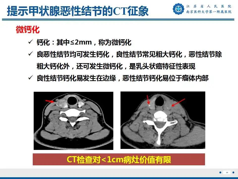 【PPT】甲状腺乳头状癌颈部淋巴结转移-30