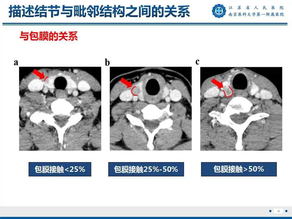 【PPT】甲状腺乳头状癌颈部淋巴结转移-31