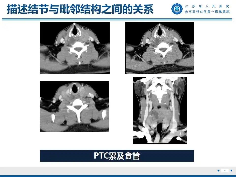 【PPT】甲状腺乳头状癌颈部淋巴结转移-33