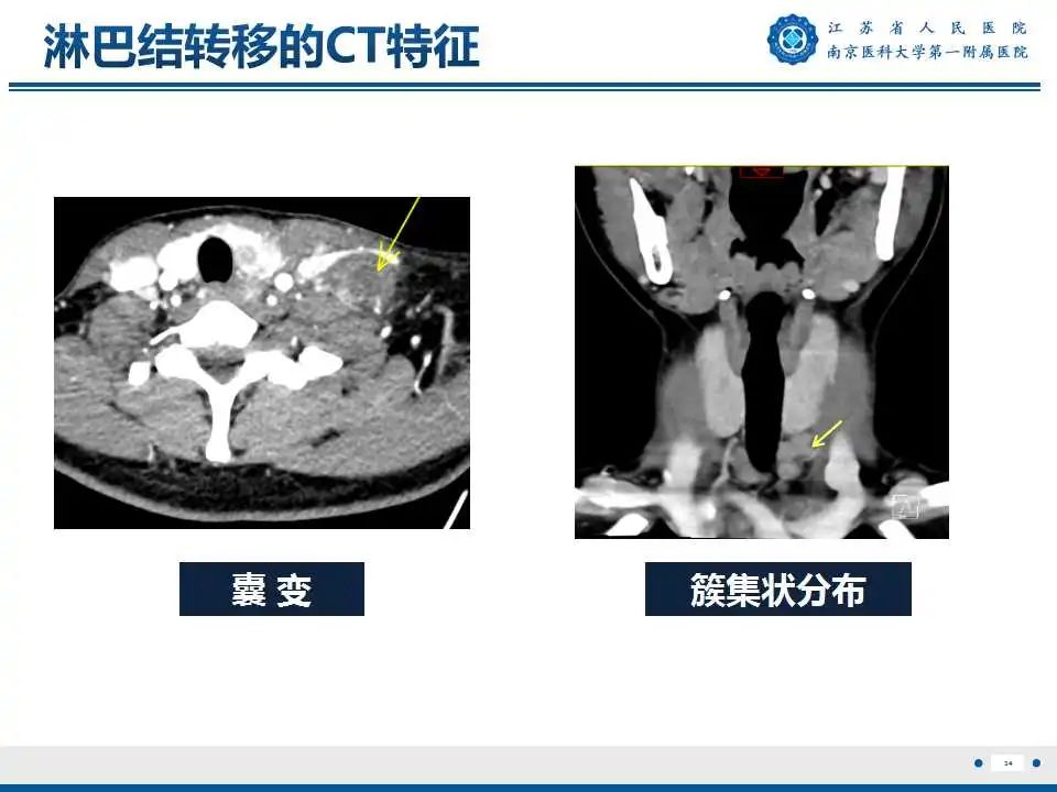 【PPT】甲状腺乳头状癌颈部淋巴结转移-35