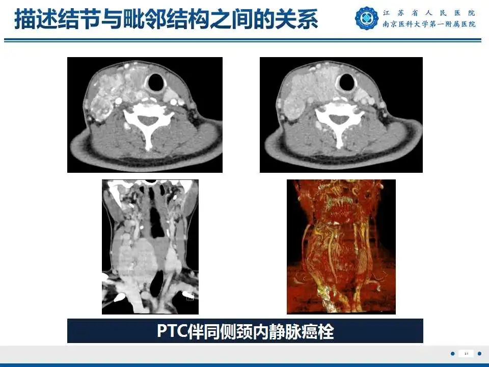 【PPT】甲状腺乳头状癌颈部淋巴结转移-32