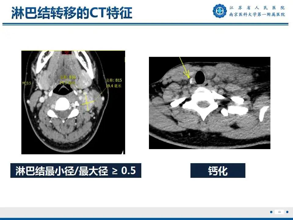 【PPT】甲状腺乳头状癌颈部淋巴结转移-34
