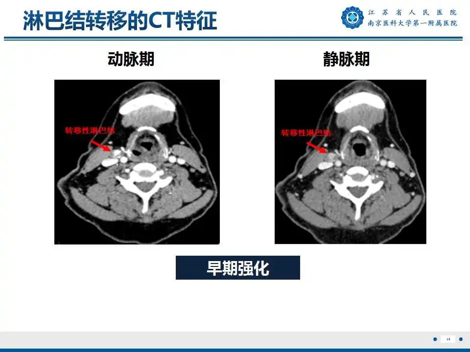 【PPT】甲状腺乳头状癌颈部淋巴结转移-36