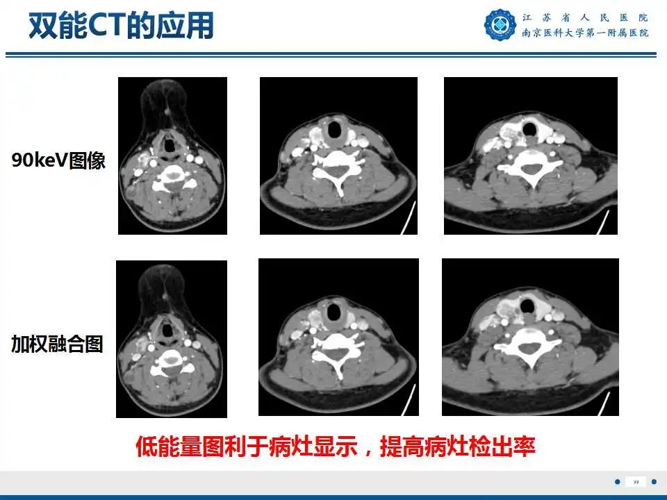 【PPT】甲状腺乳头状癌颈部淋巴结转移-40