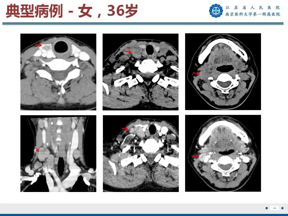 【PPT】甲状腺乳头状癌颈部淋巴结转移-44