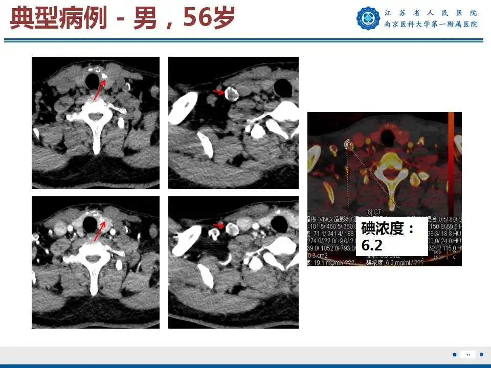 【PPT】甲状腺乳头状癌颈部淋巴结转移-45