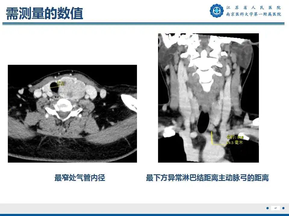 【PPT】甲状腺乳头状癌颈部淋巴结转移-48