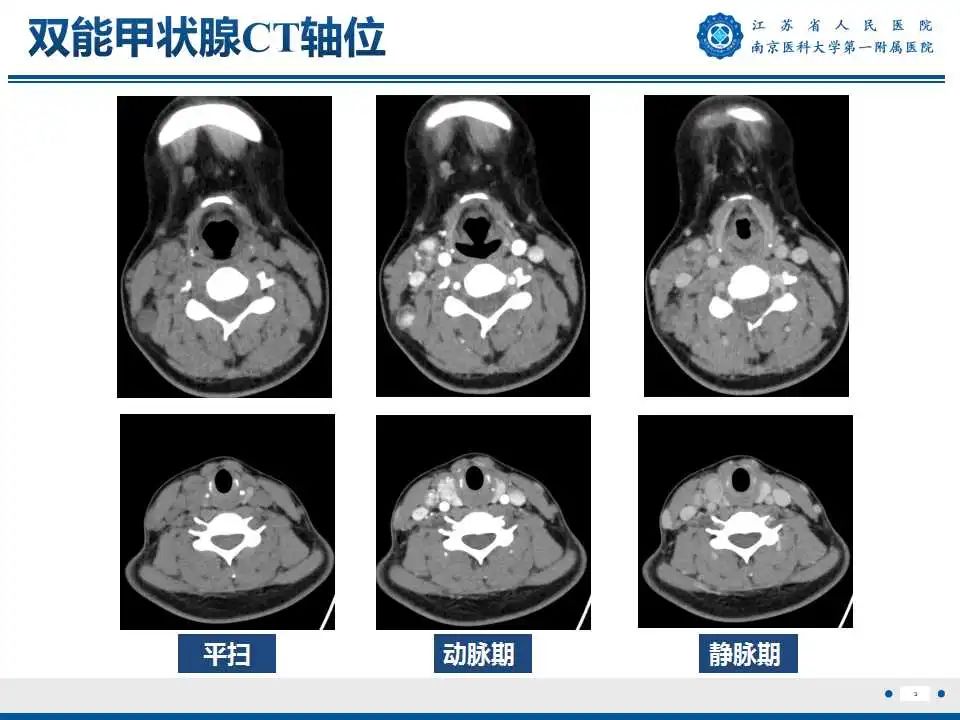 【PPT】甲状腺乳头状癌颈部淋巴结转移-4