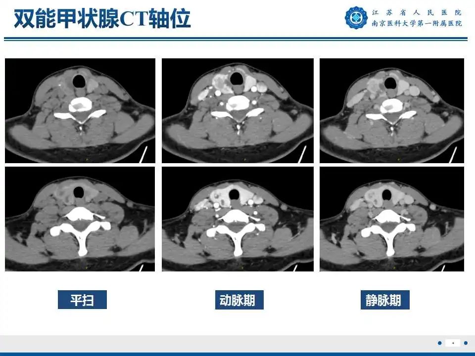【PPT】甲状腺乳头状癌颈部淋巴结转移-5