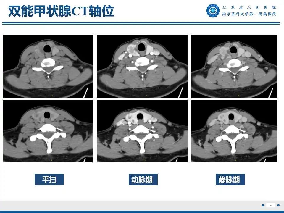 【PPT】甲状腺乳头状癌颈部淋巴结转移-5